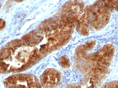 FFPE human prostate carcinoma sections stained with 100 ul anti-TAG-72 / CA72.4 (clone B72.3 + CC49) at 1:400. HIER epitope retrieval prior to staining was performed in 10mM Citrate, pH 6.0.